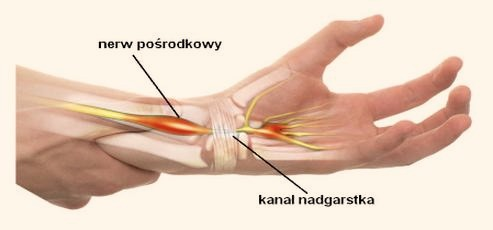 Cieśń nadgarstka: ile trwa L4 i kiedy bezpiecznie wrócić do pracy?
