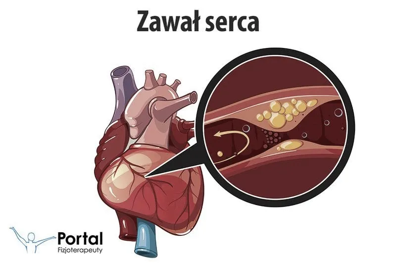 Ile zwolnienia lekarskiego po zawale serca? Zasady i czas powrotu do pracy